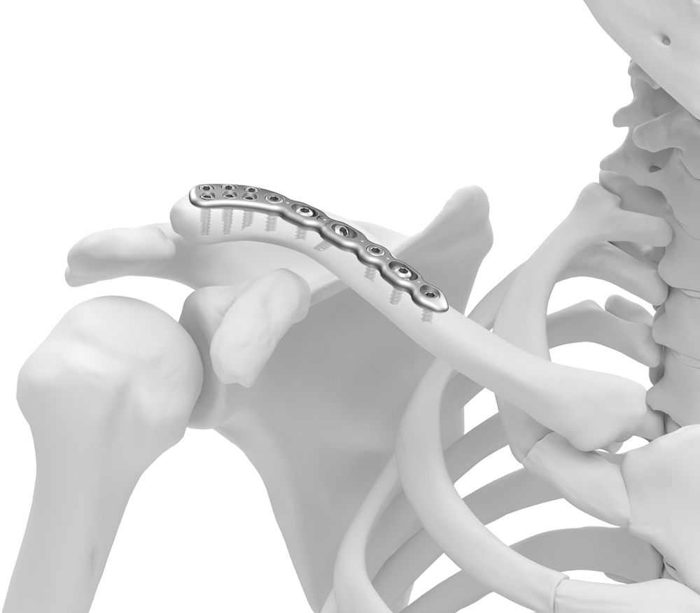 TriMed CFS Superior Lateral Plate fixated to 3d clavicle model