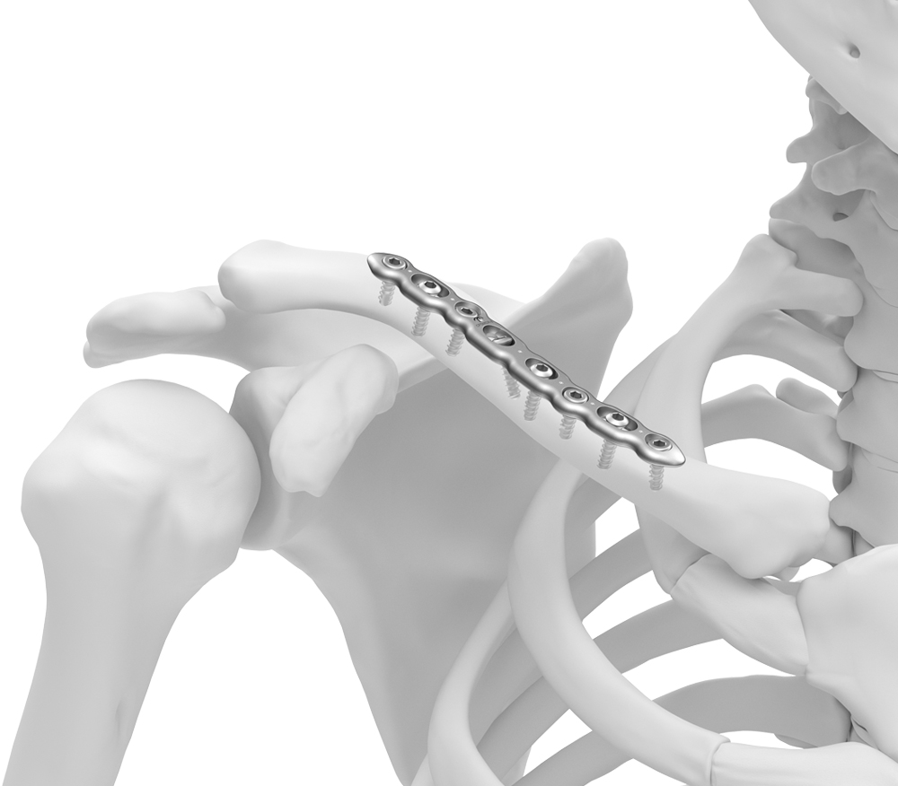 TriMed CFS Superior Midshaft Plate fixated to 3d clavicle model