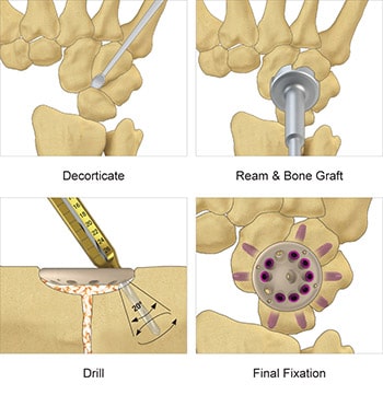Fusion Cup surgical technique for hand fixation