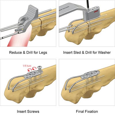 Surgical technique preview for the TriMed Olecranon Sled system