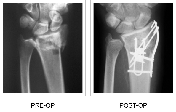 Pre and post-op x-rays