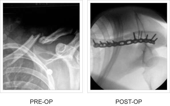 Pre-op vs Post-op x-ray comparisons