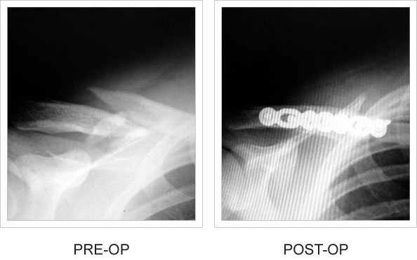 X-rays from before and after implant was fixated