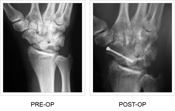 X-ray comparison of pre and post-op screw implantation