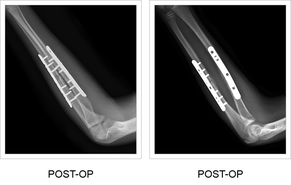 Pre and post-op x-ray comparison