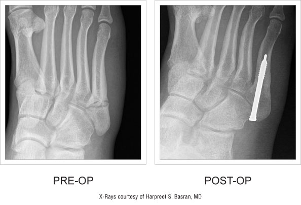 Jones Screw pre and post-op x-ray comparison