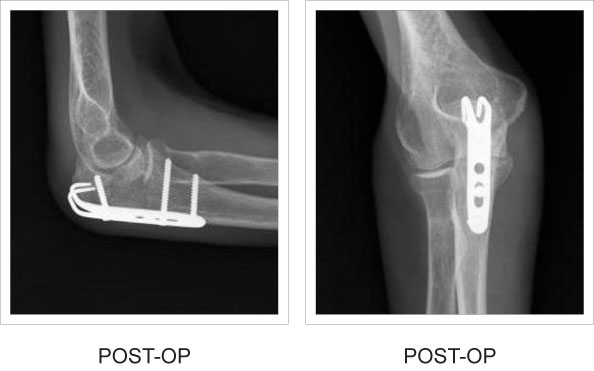 Olecranon Hook Plate pre and post-op x-rays