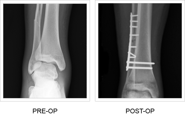 Pre-op and post-op x-ray comparison