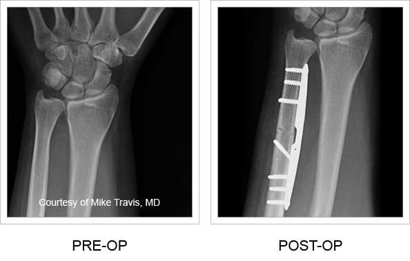 X-rays from pre-op and post-op
