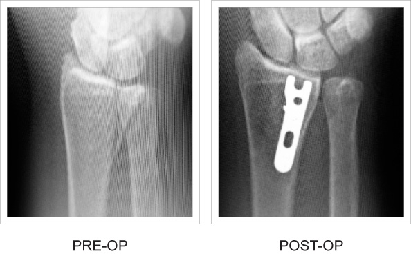 Side-by-side x-ray comparison pre and post-op