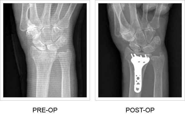 TriMed's Volar Bearing Plate, X-rays of Pre & Post-Op