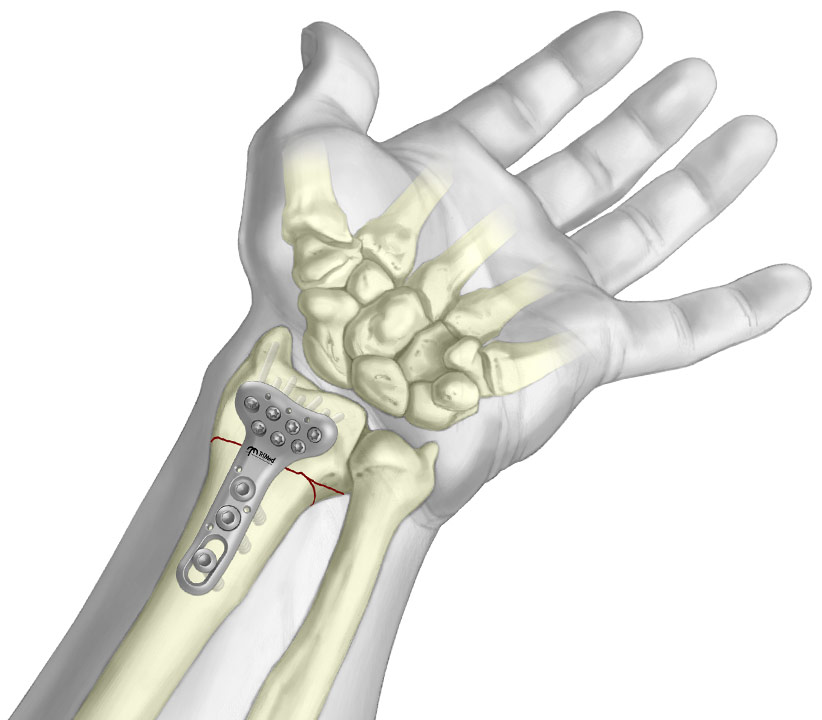 Graphic of Volar Fixed Angle Plate fixated to periarticular radial fracture.