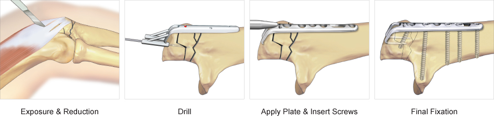 Olecranon Hook Plate surgical technique
