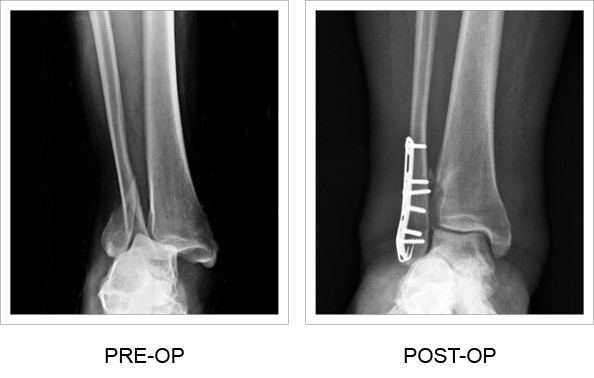Posterior pre and post-op x-rays of the Ankle Hook Plate