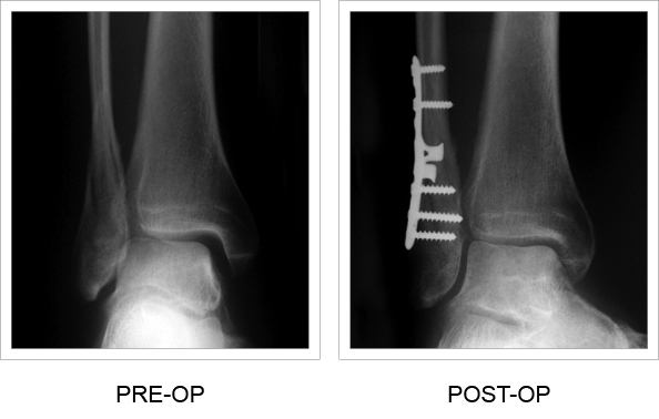 Pre and post-operation comparison x-rays