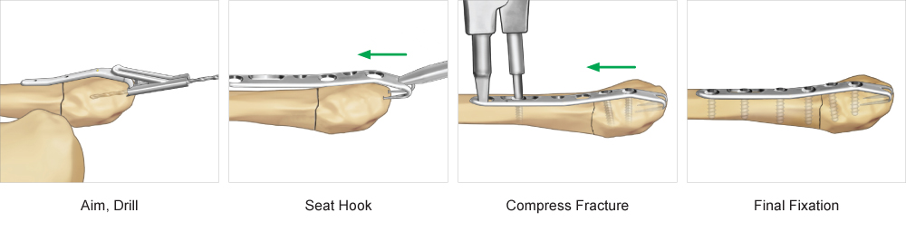 Surgical technique for Ankle Hook Plate fixation