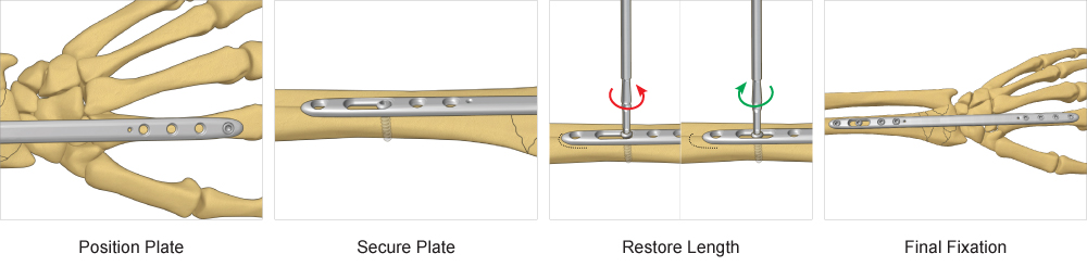 Step-by-Step surgical technique for Bridge Plate fixation