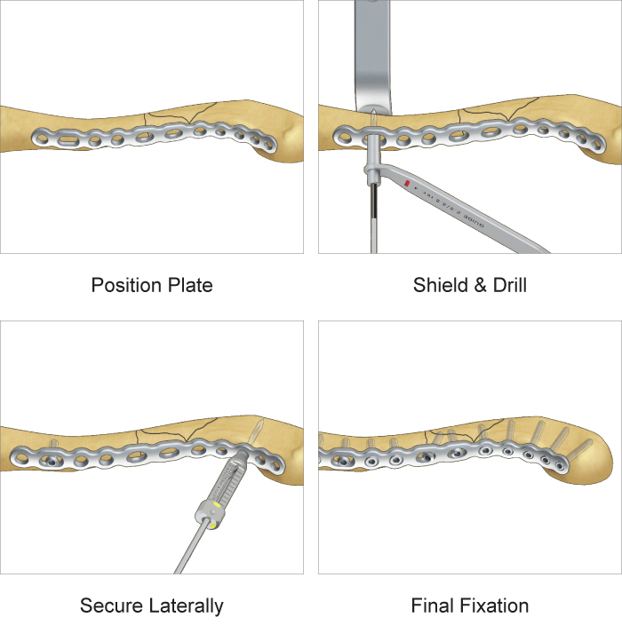 Surgical technique for TriMed's Anterior Clavicle Plate system