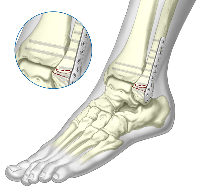 4.0 Cortical Screw system fixated to Fibula fracture