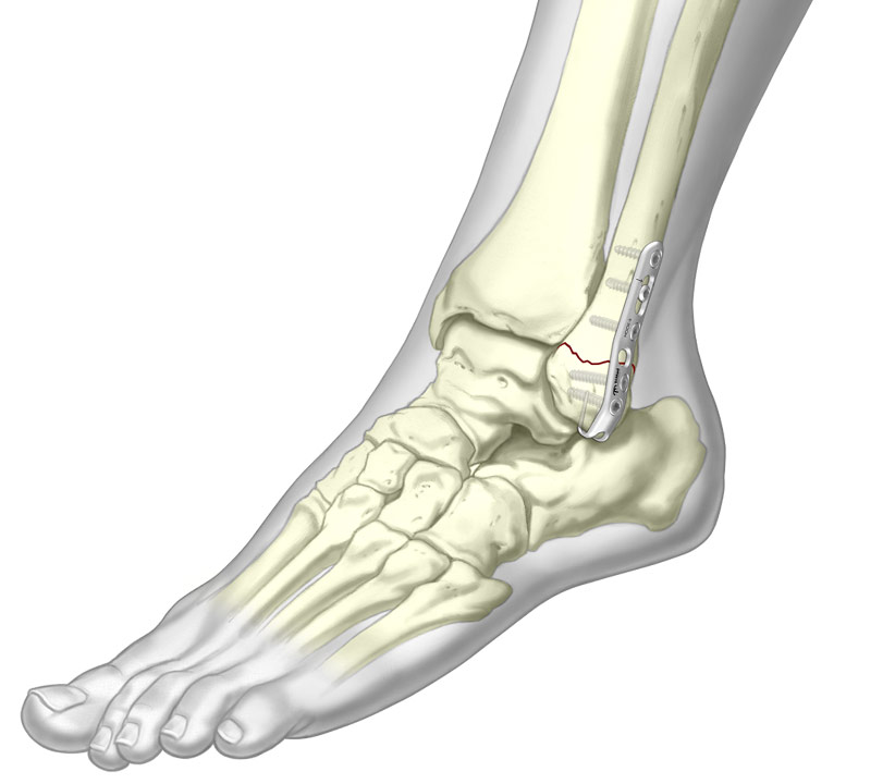 Illustrated Ankle Hook Plate fixated to fibula fracture