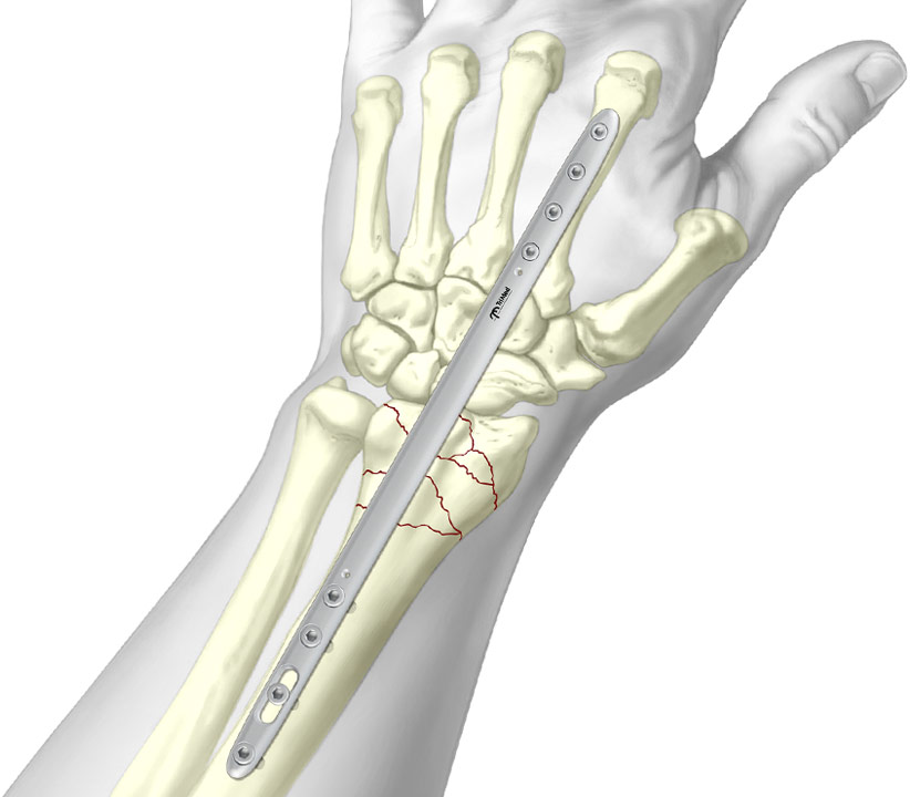 Bridge Plate wrist fixation system fixated to complex radial fracture