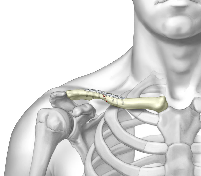 Superior Midshaft Clavicle Plate system fixated to fractured Clavicle bone