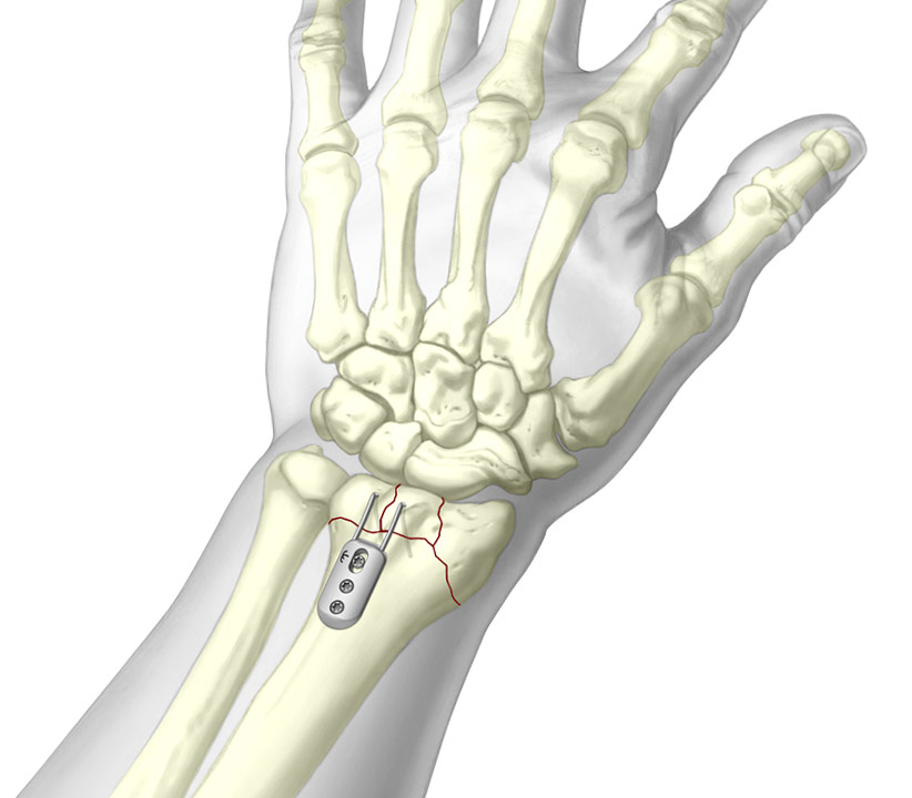 3D Illustration of TriMed's Dorsal Buttress Pin System fixated to wrist fracture