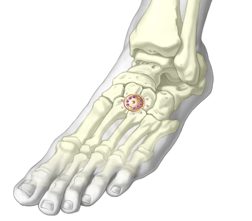 Lower Fusion Cup Fixation system installed onto metatarsal and cuneiform bones