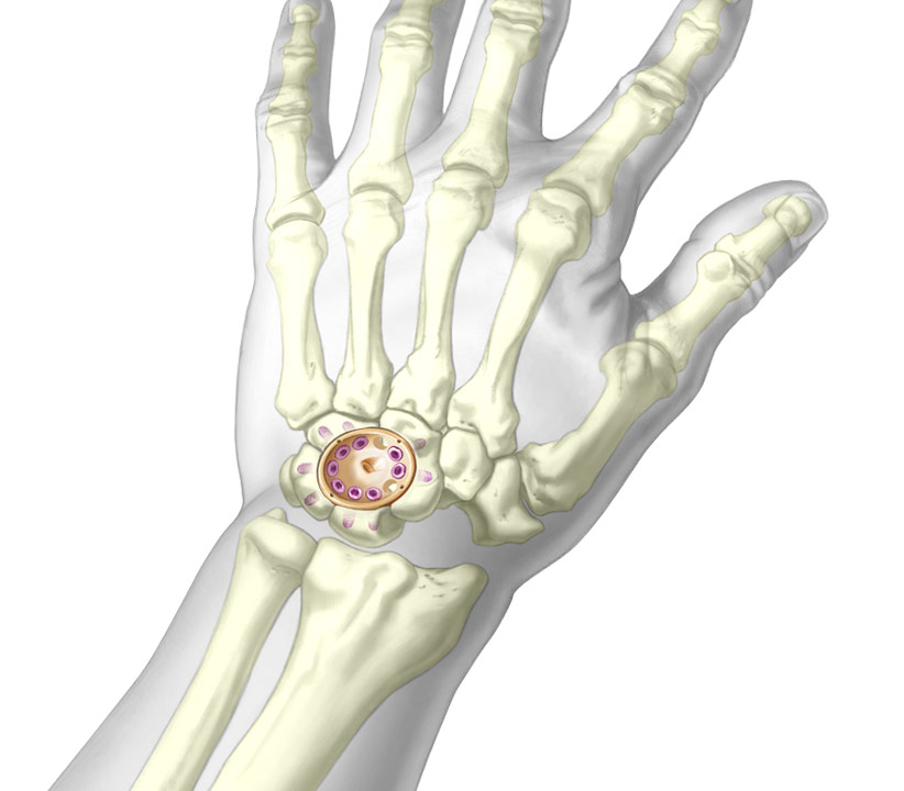 Upper fusion cup illustration of fixation in wrist