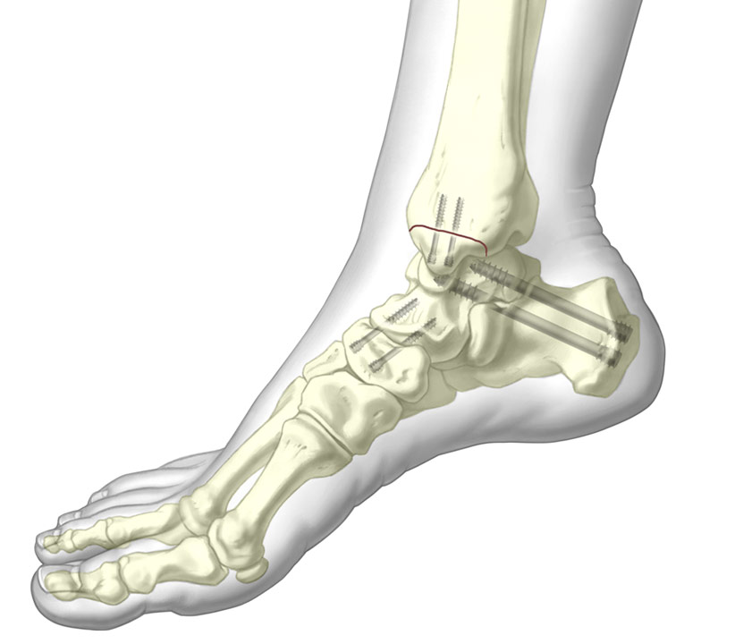 4.5, 5.5, and 7.3mm Cannulated Screw System installed into the Tibia, Cuneiform, and Calcaneus bones.