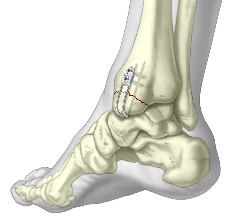 Medial malleolar sled fixated to periarticular Tibia fracture