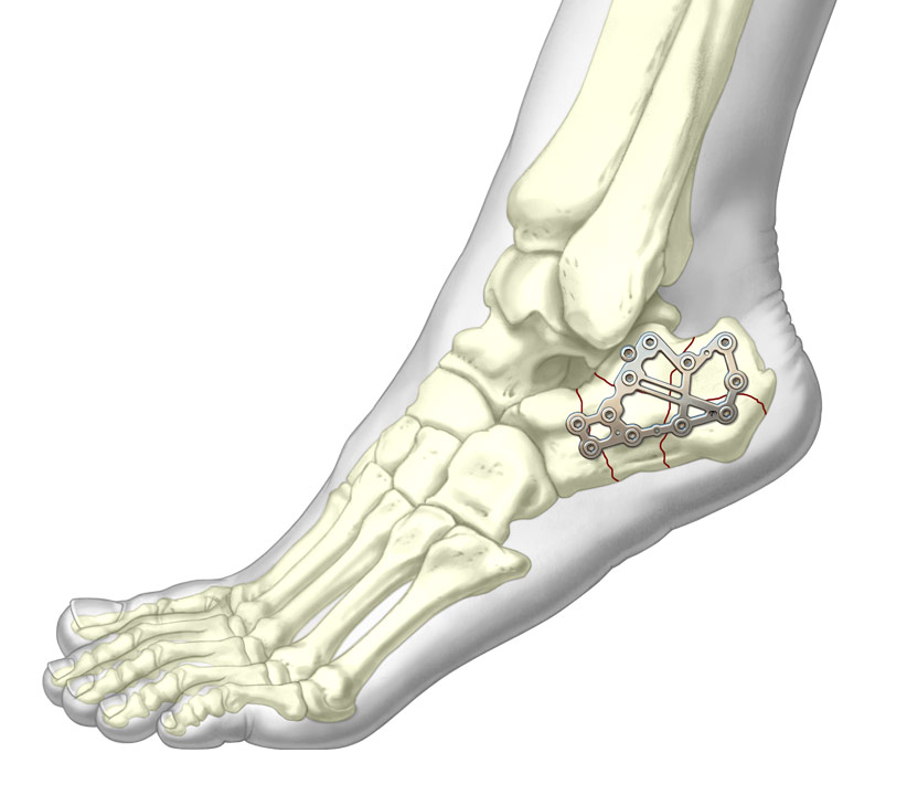 Calcaneal Perimeter Plate system over complex calcaneal fracture
