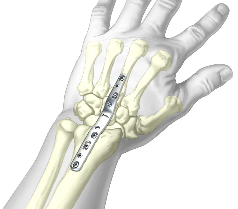 Graphic of installed Total Wrist Fusion Plate System
