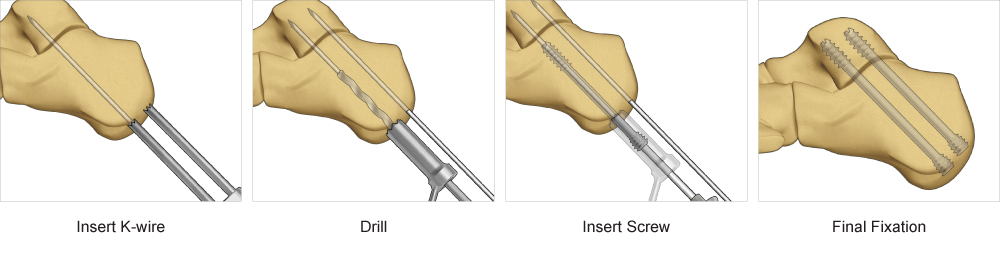 Surgical technique steps for screw system implants