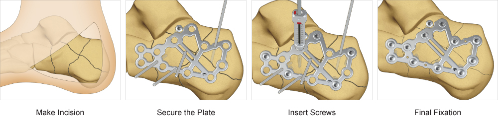 Surgical Technique for Calcaneal Perimeter Plate implant