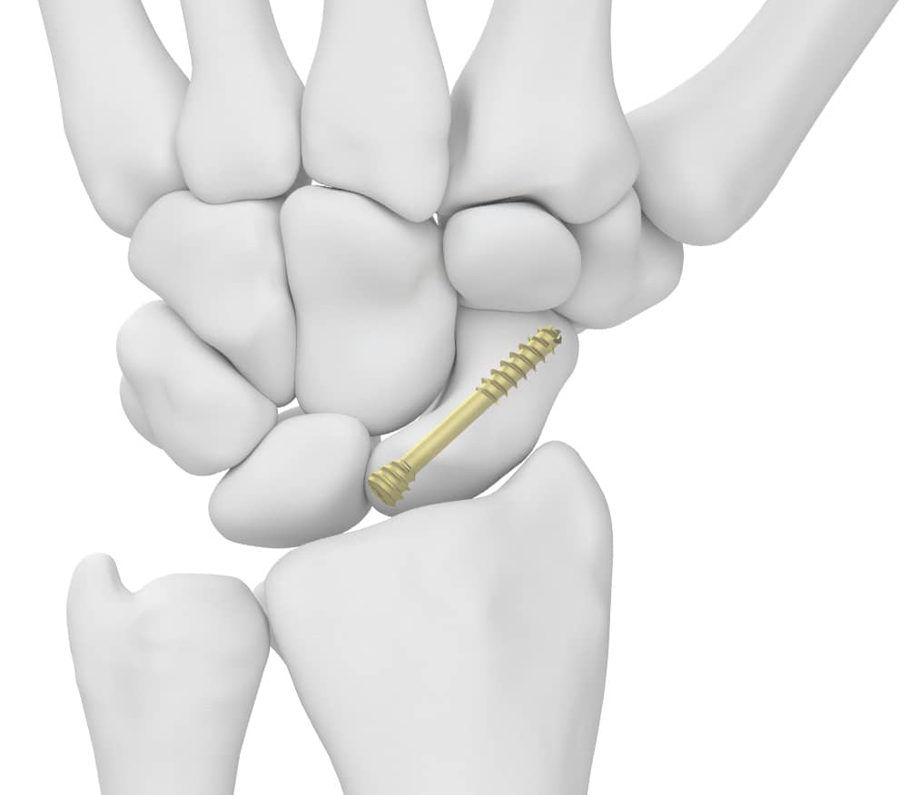 Scaphoid Screw fixated to 3d wrist model