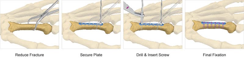 Surgical technique preview for TriMed's hand plate system