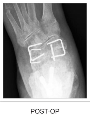 Post-op x-ray of staples in the foot