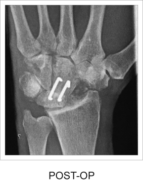 Post operation x-ray of the Nitinol Staple system