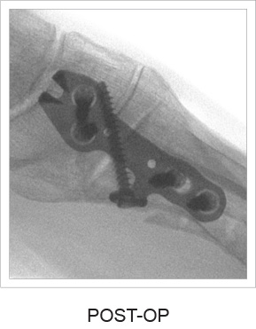 Lapidus Hook Plate post-op x-ray