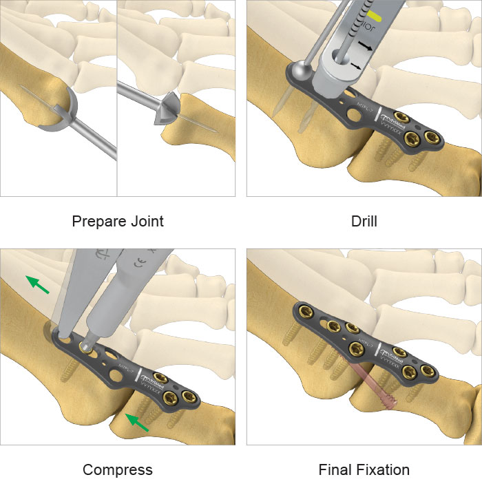 Graphic of step-by-step surgical technique