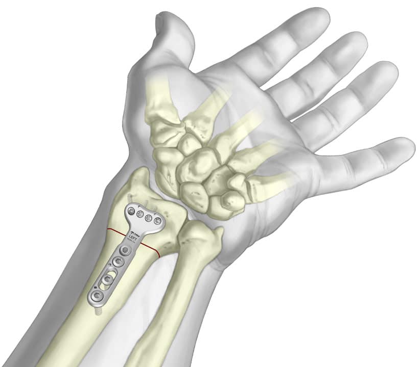 Radial Osteotomy Plate fixated to radial osteotomy site