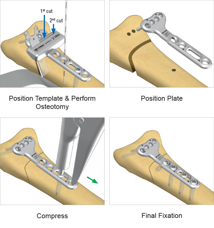 Radial Osteotomy Plate surgical technique