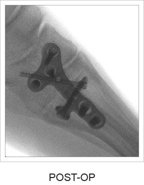 Post-op x-ray