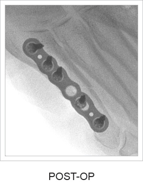 ASET Straight Plate post-op x-ray