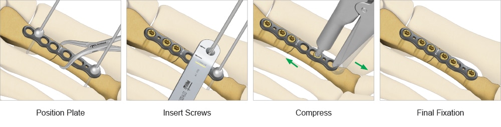 Overview of the ASET™ Straight Plate fixation process