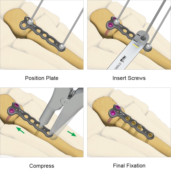 Steps in the ASET™ T-Plate surgical process