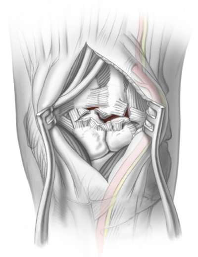Surgical opening of area above fracture