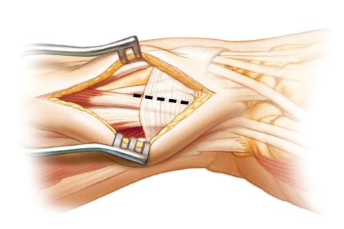 Tendon release of the frst dorsal extensor compartment