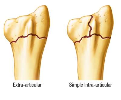 Extra-articular and simple intra-articular fracture indications of the distal radius